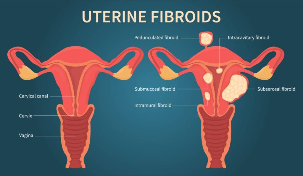 Fibroid Facts