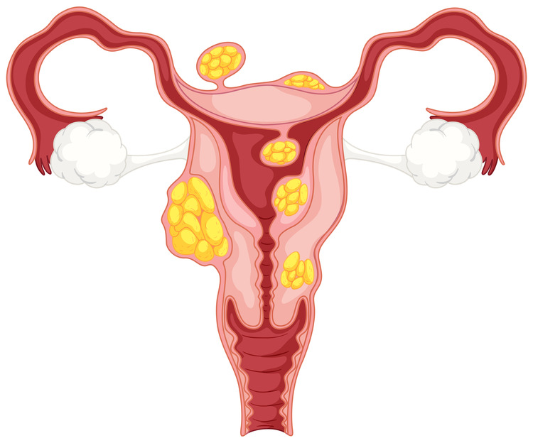 Fibroids